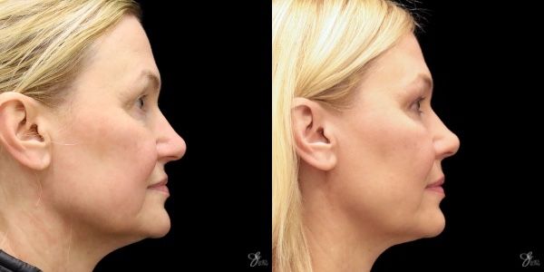 Facial Rejuvenation Before & After