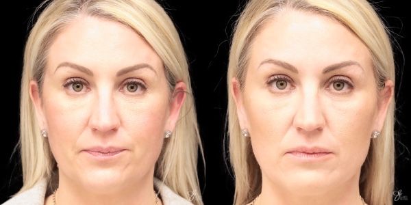 Facial Rejuvenation Before & After