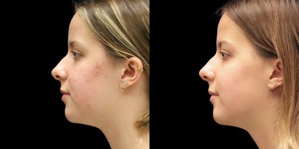 Facial Rejuvenation Before & After