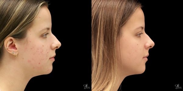 Facial Rejuvenation Before & After