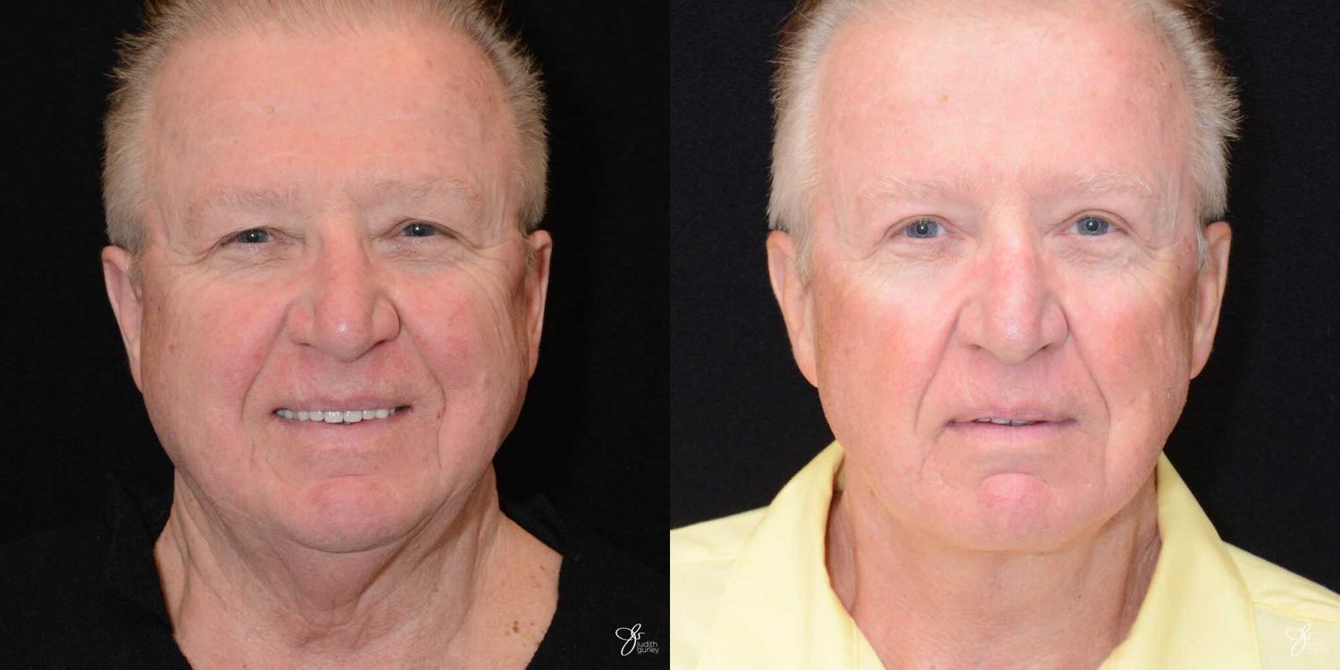 Facial Rejuvenation Before & After