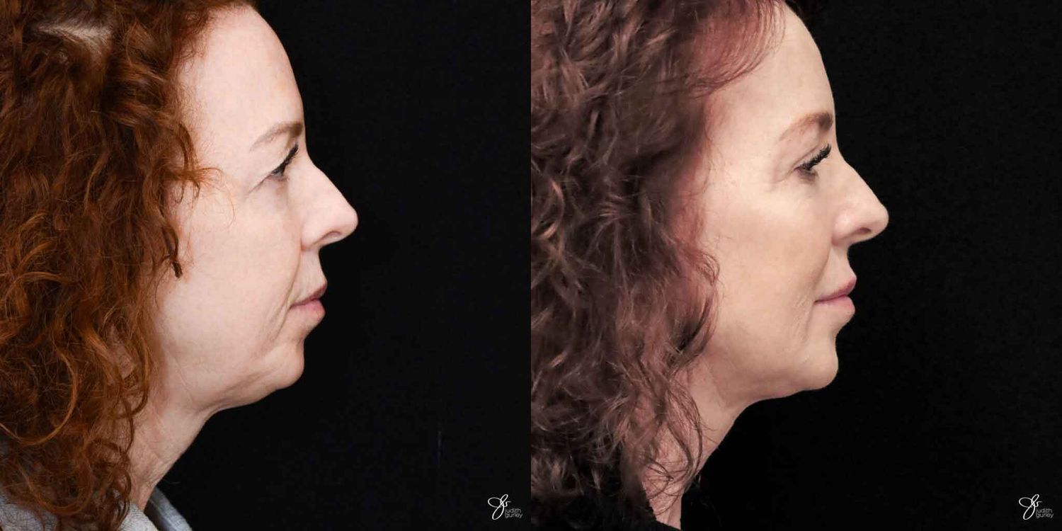 Facial Rejuvenation Before & After