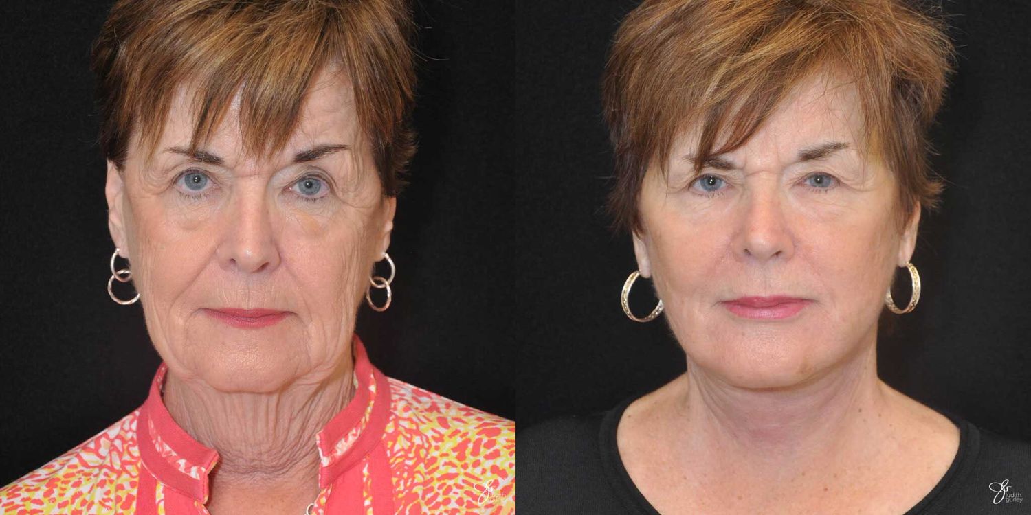 Facial Rejuvenation Before & After