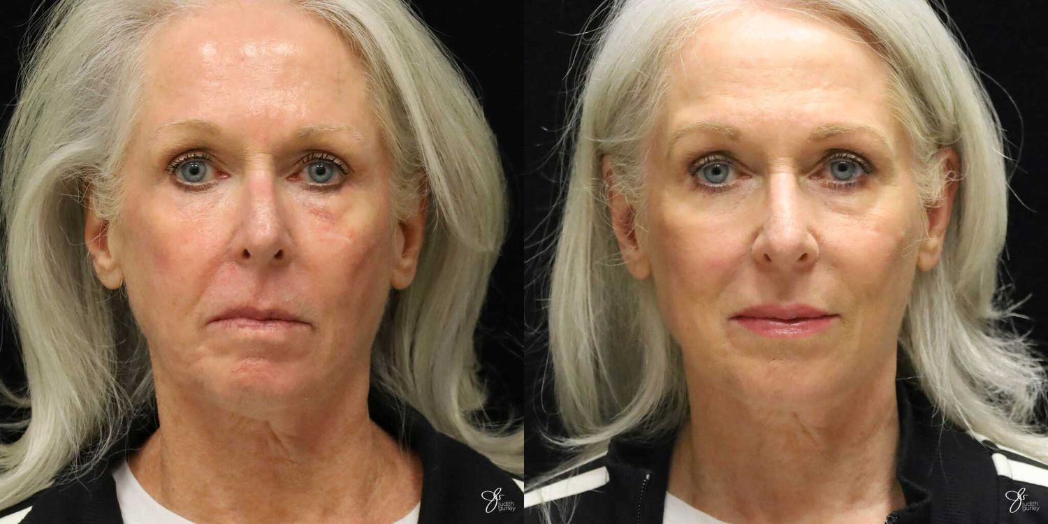 Facial Rejuvenation Before & After