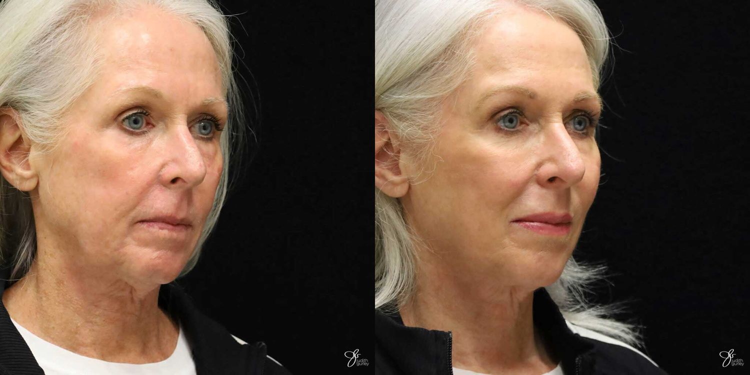 Facial Rejuvenation Before & After