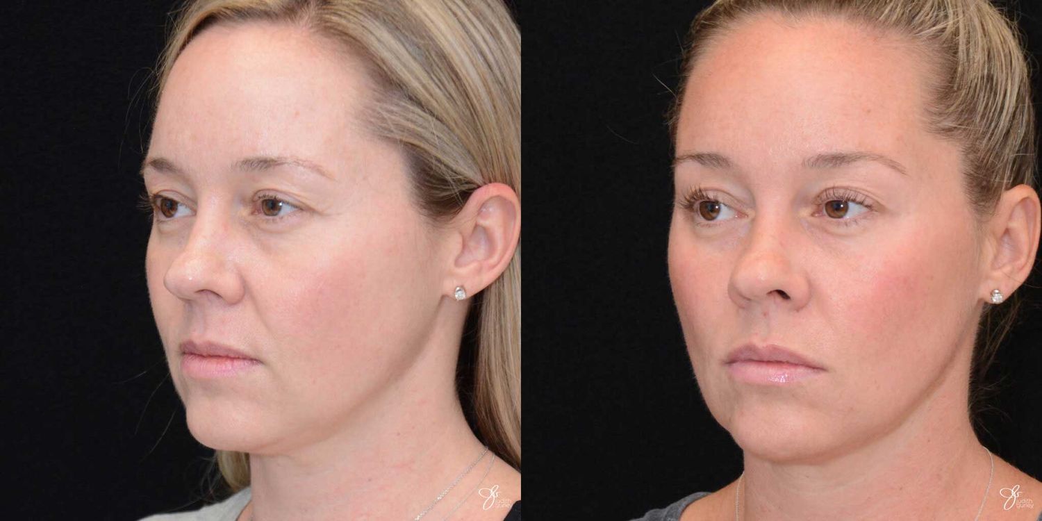 Facial Rejuvenation Before & After