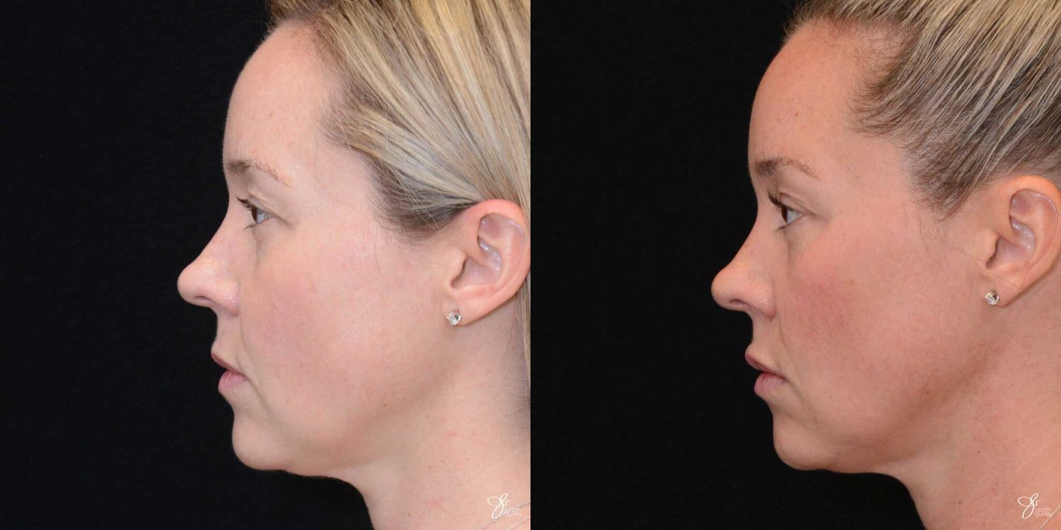 Facial Rejuvenation Before & After