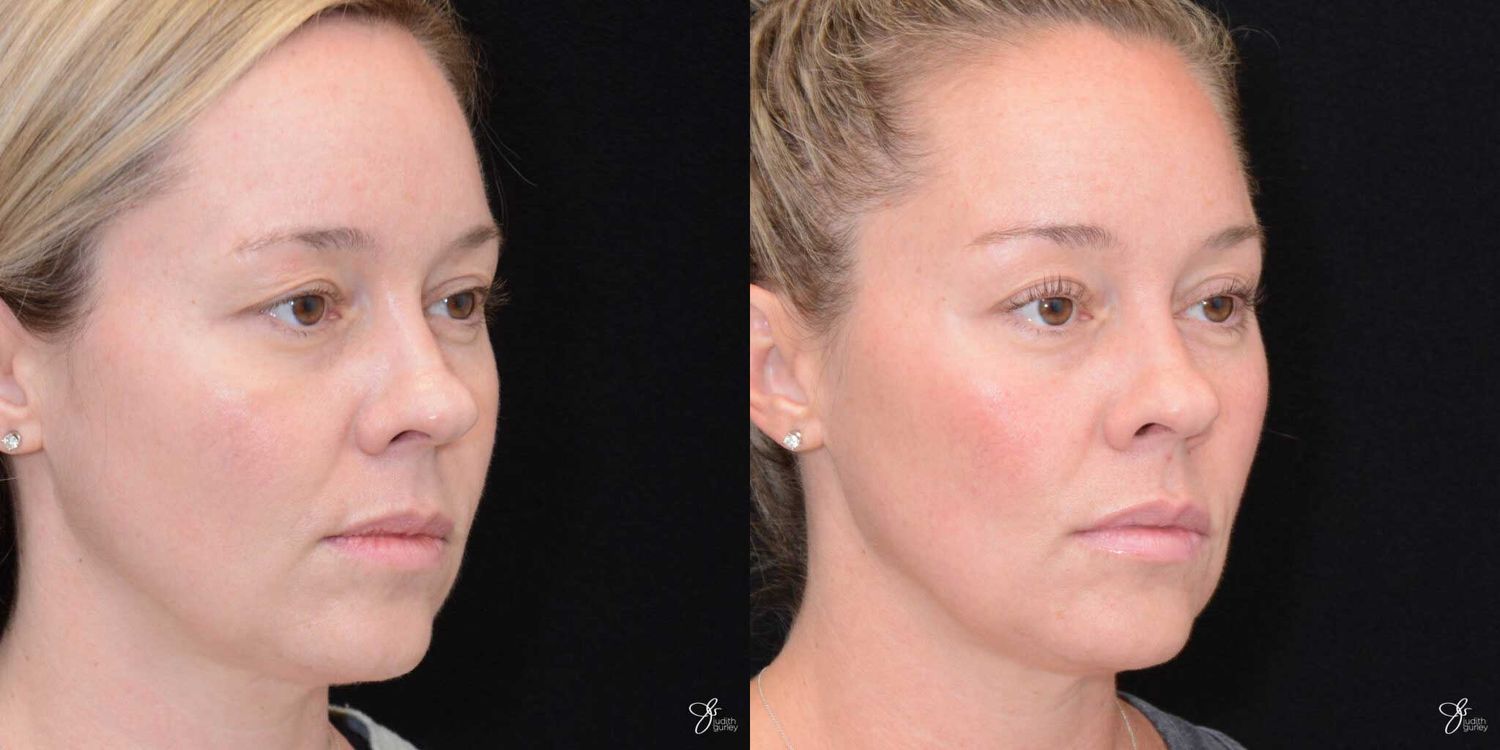 Facial Rejuvenation Before & After