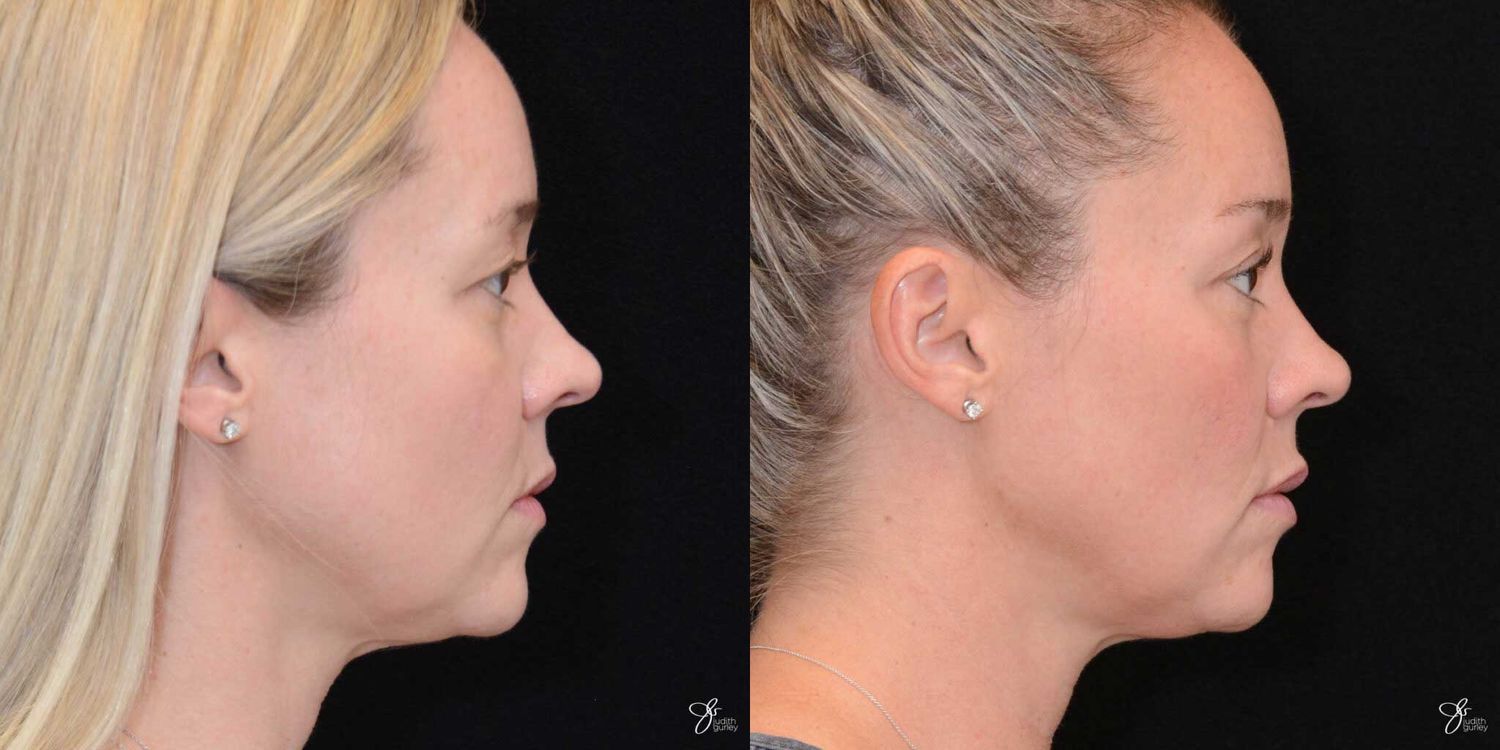 Facial Rejuvenation Before & After