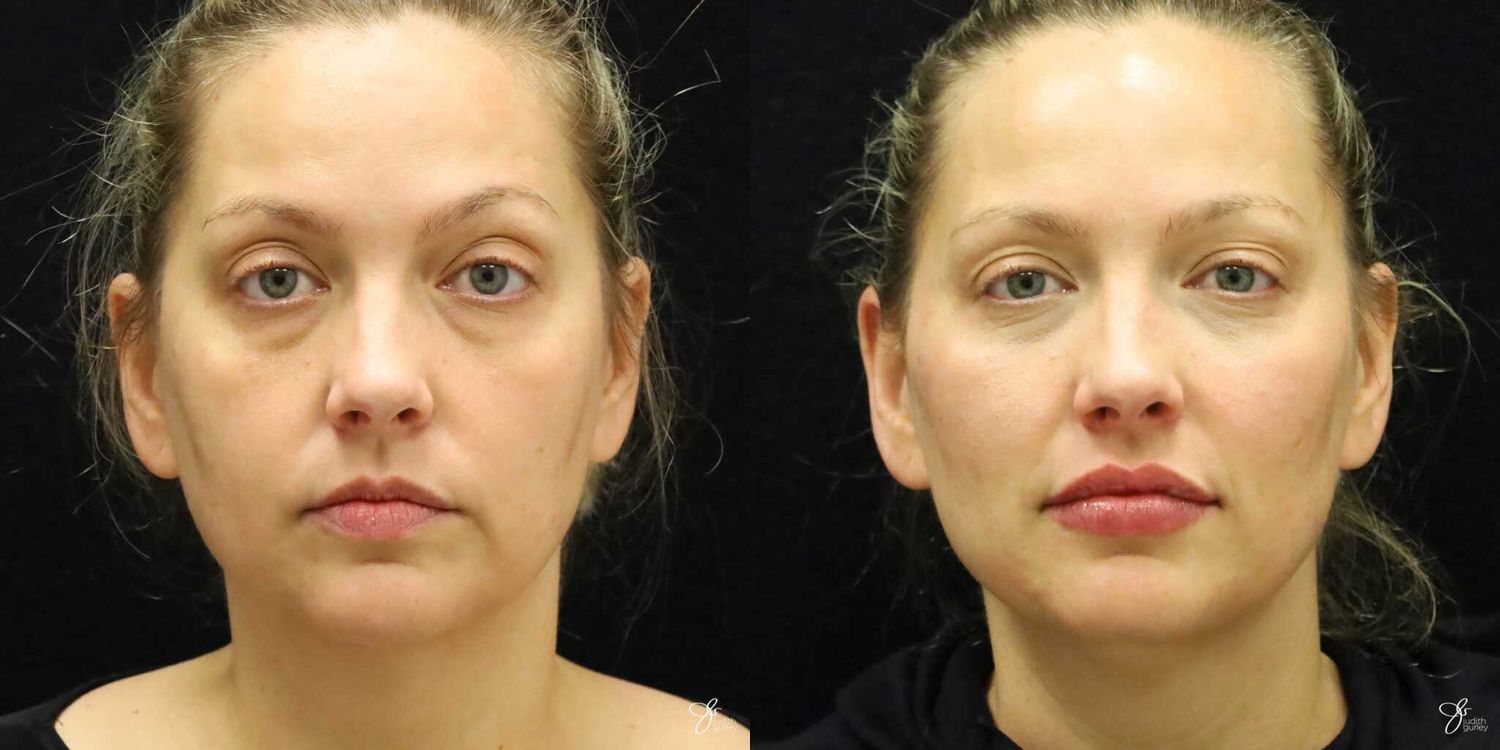 Facial Rejuvenation Before & After