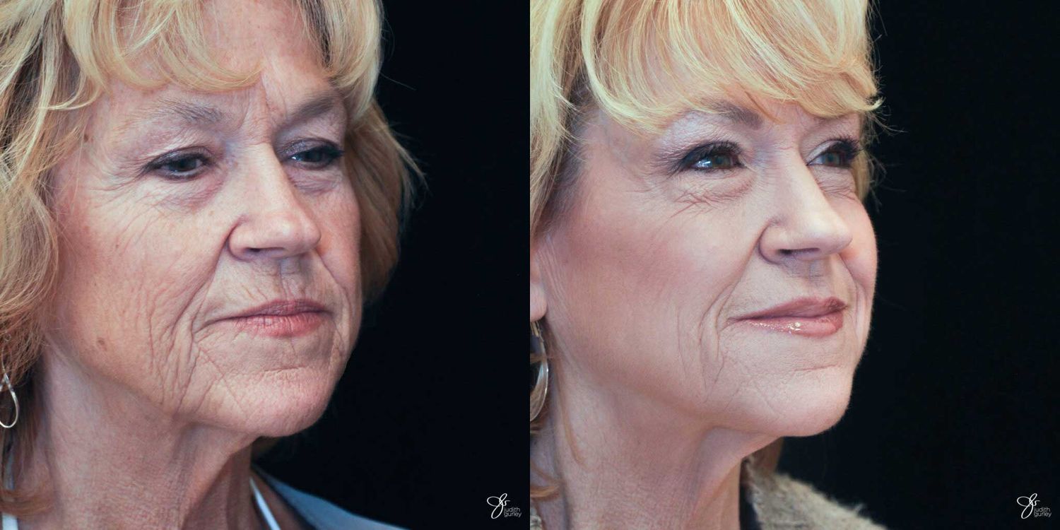 Facial Rejuvenation Before & After