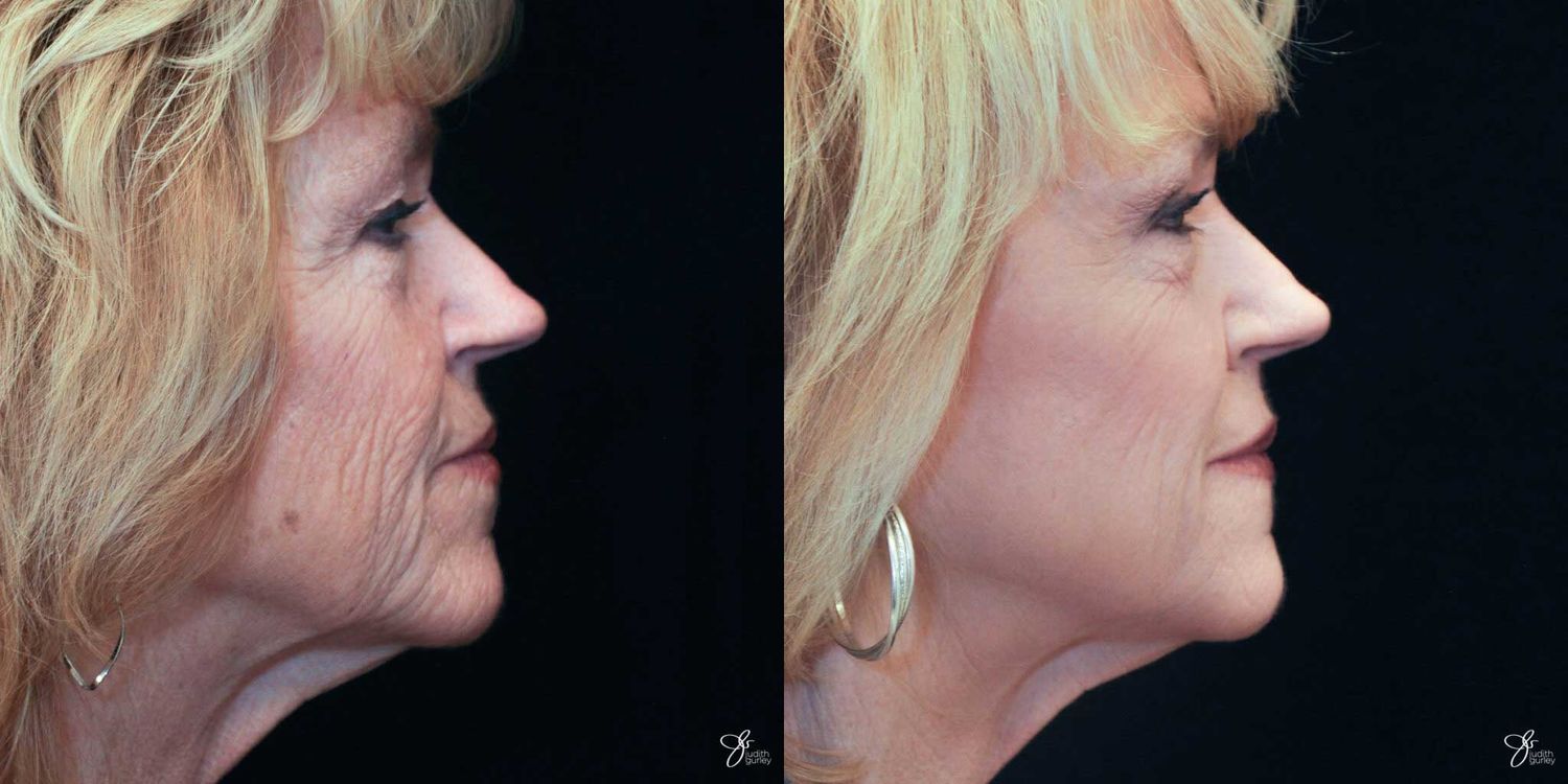 Facial Rejuvenation Before & After