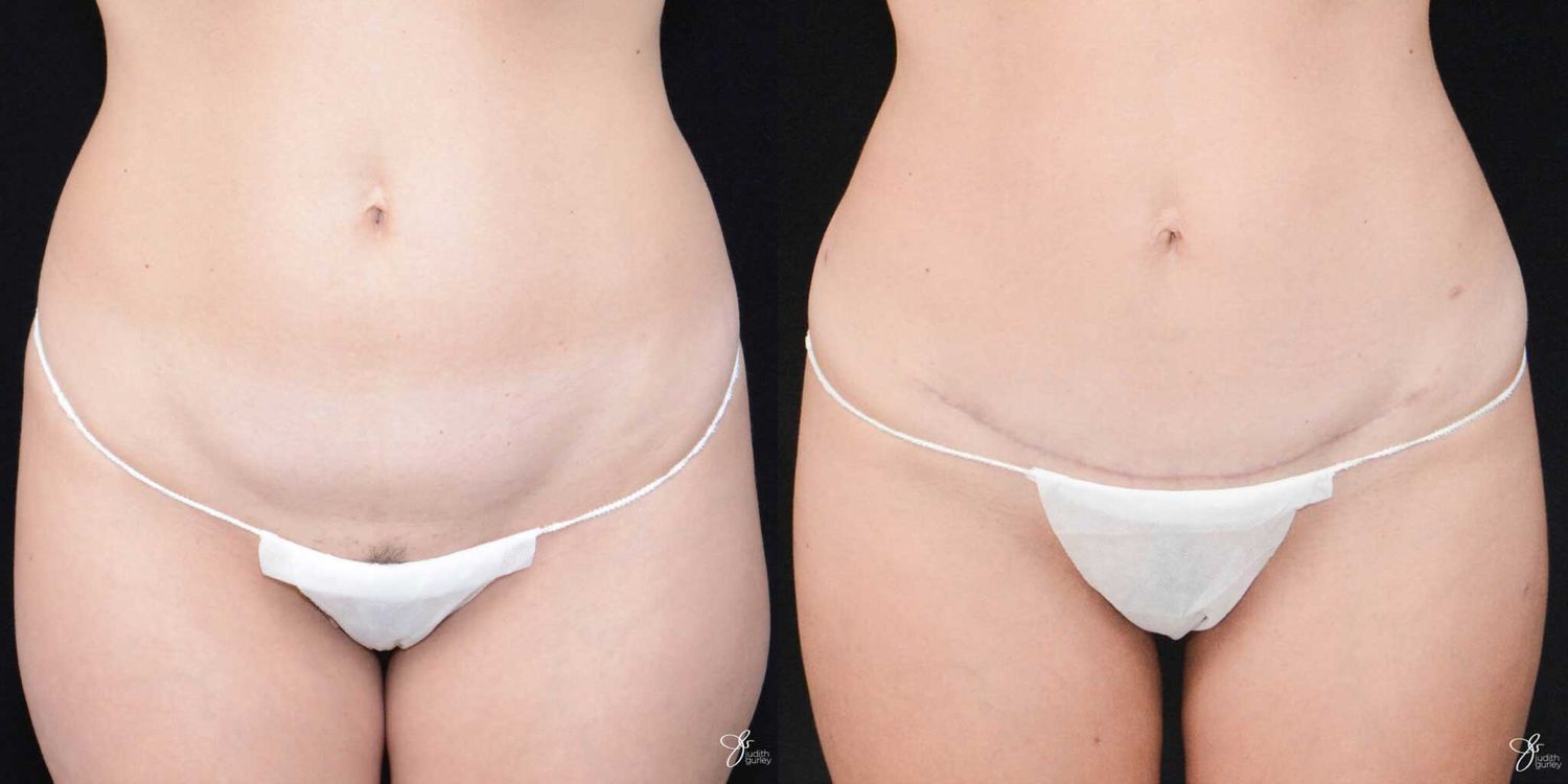 C Section Scar Correction Before & After