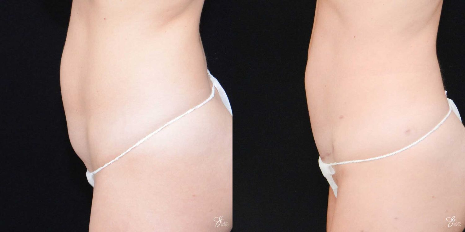 C Section Scar Correction Before & After