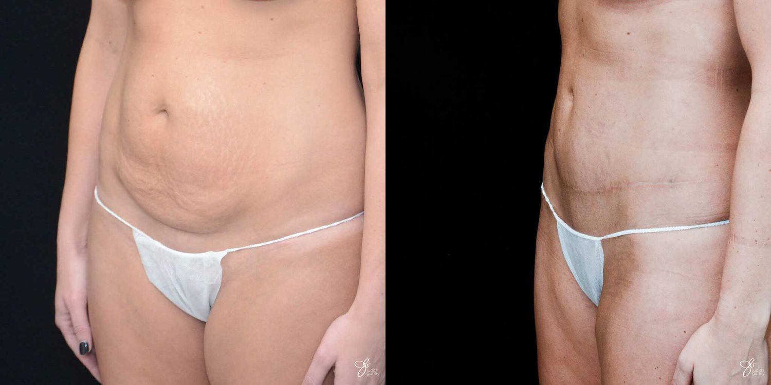 C Section Scar Correction Before & After
