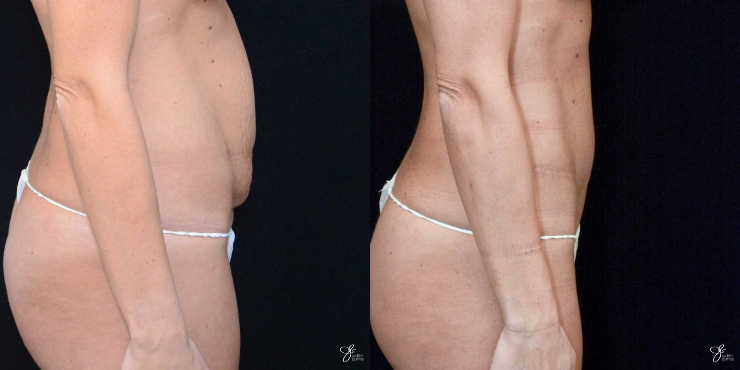 C Section Scar Correction Before & After