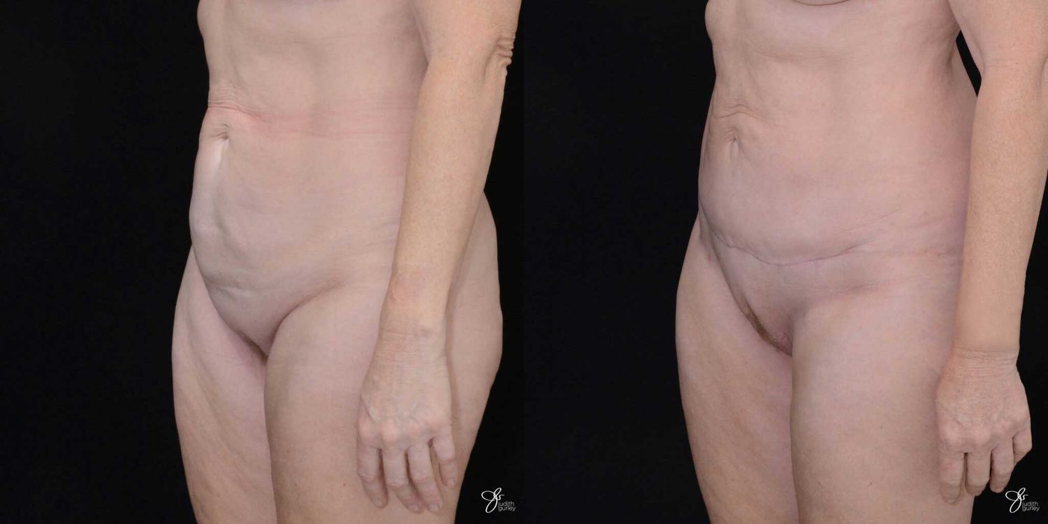 C Section Scar Correction Before & After
