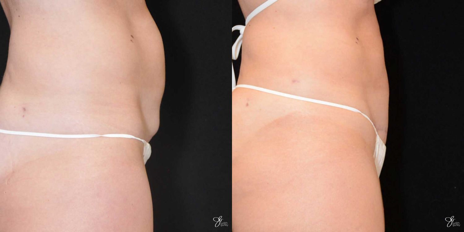 C Section Scar Correction Before & After