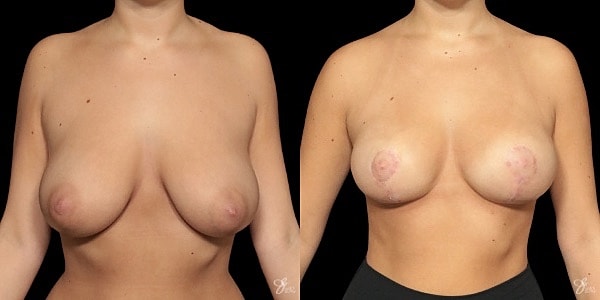 Adolescent Breast Correction Before & After