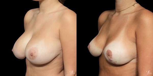 Adolescent Breast Correction Before & After