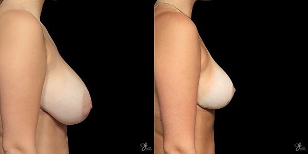 Adolescent Breast Correction Before & After