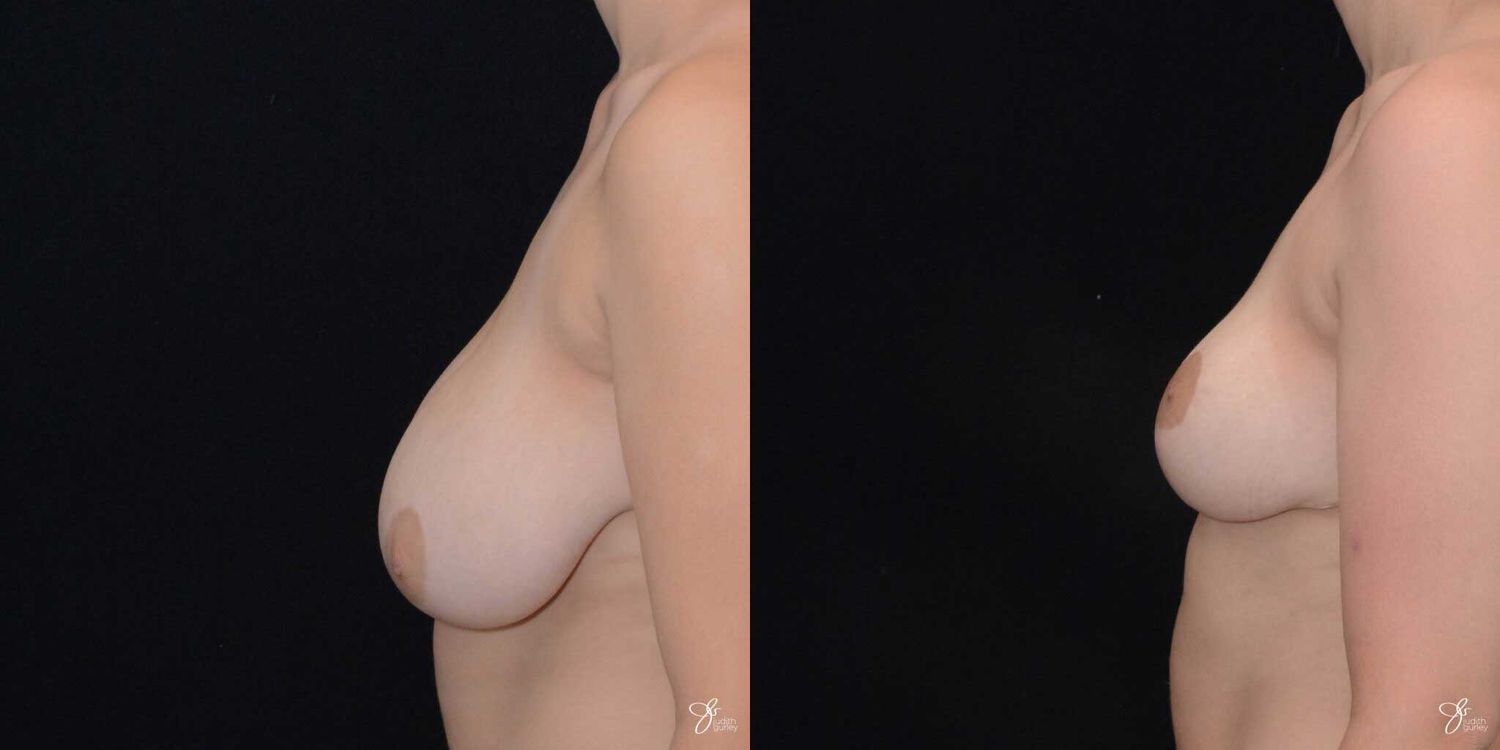 Adolescent Breast Correction Before & After