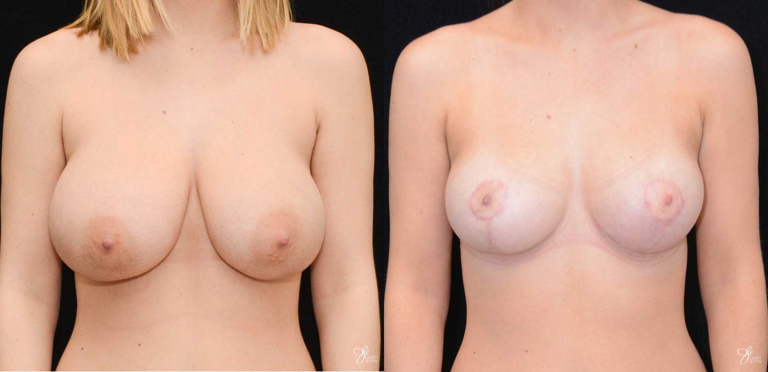 Adolescent Breast Correction Before & After