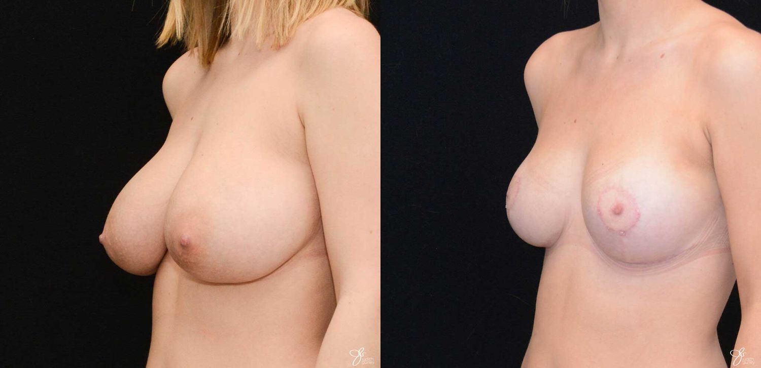 Adolescent Breast Correction Before & After