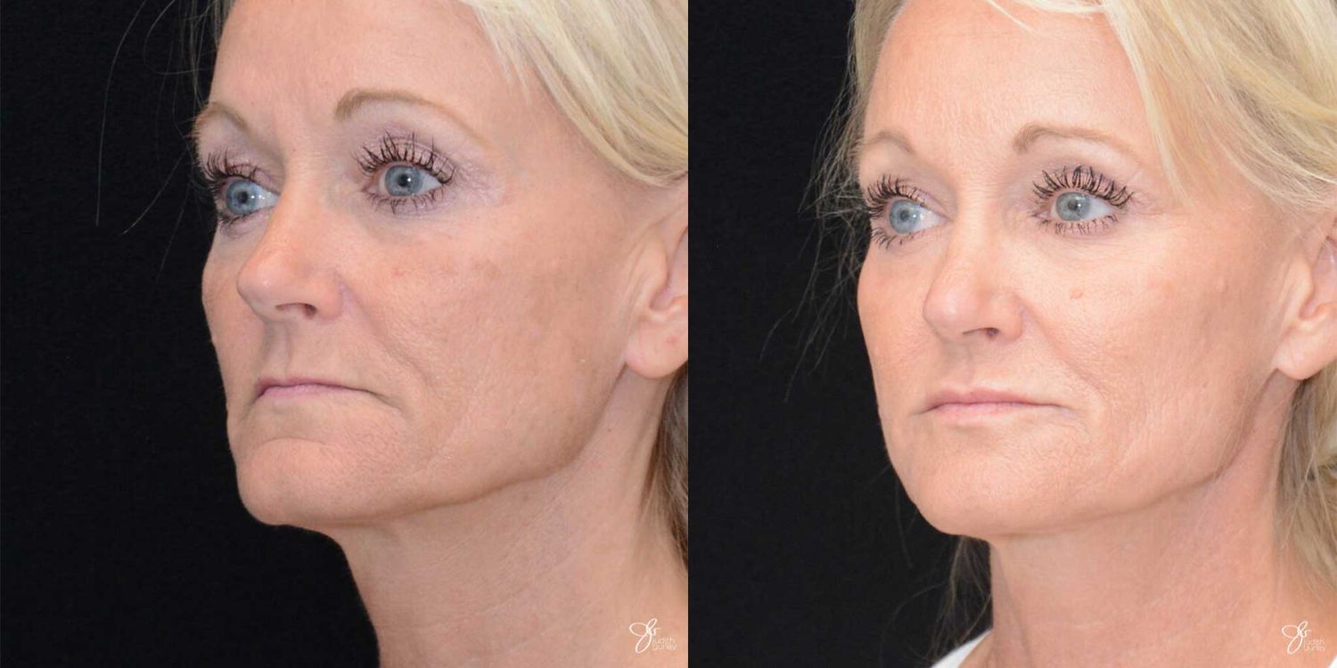 Facial Fat Grafting Before & After