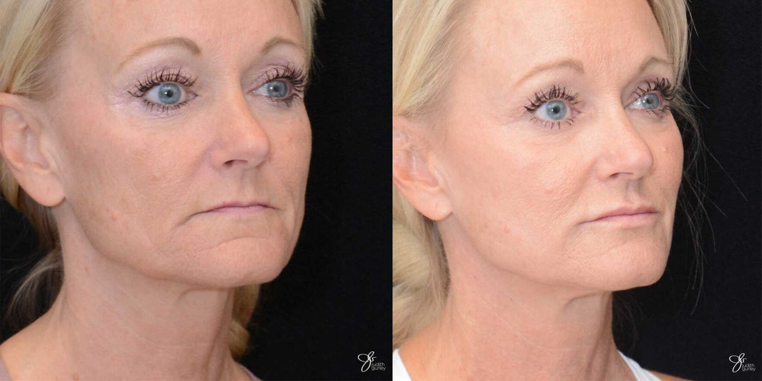 Facial Fat Grafting Before & After