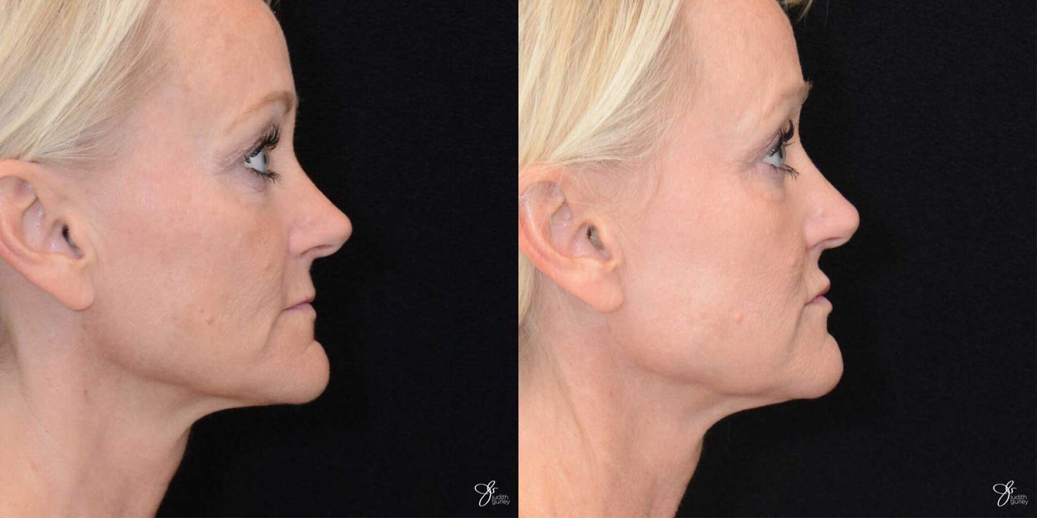 Facial Fat Grafting Before & After