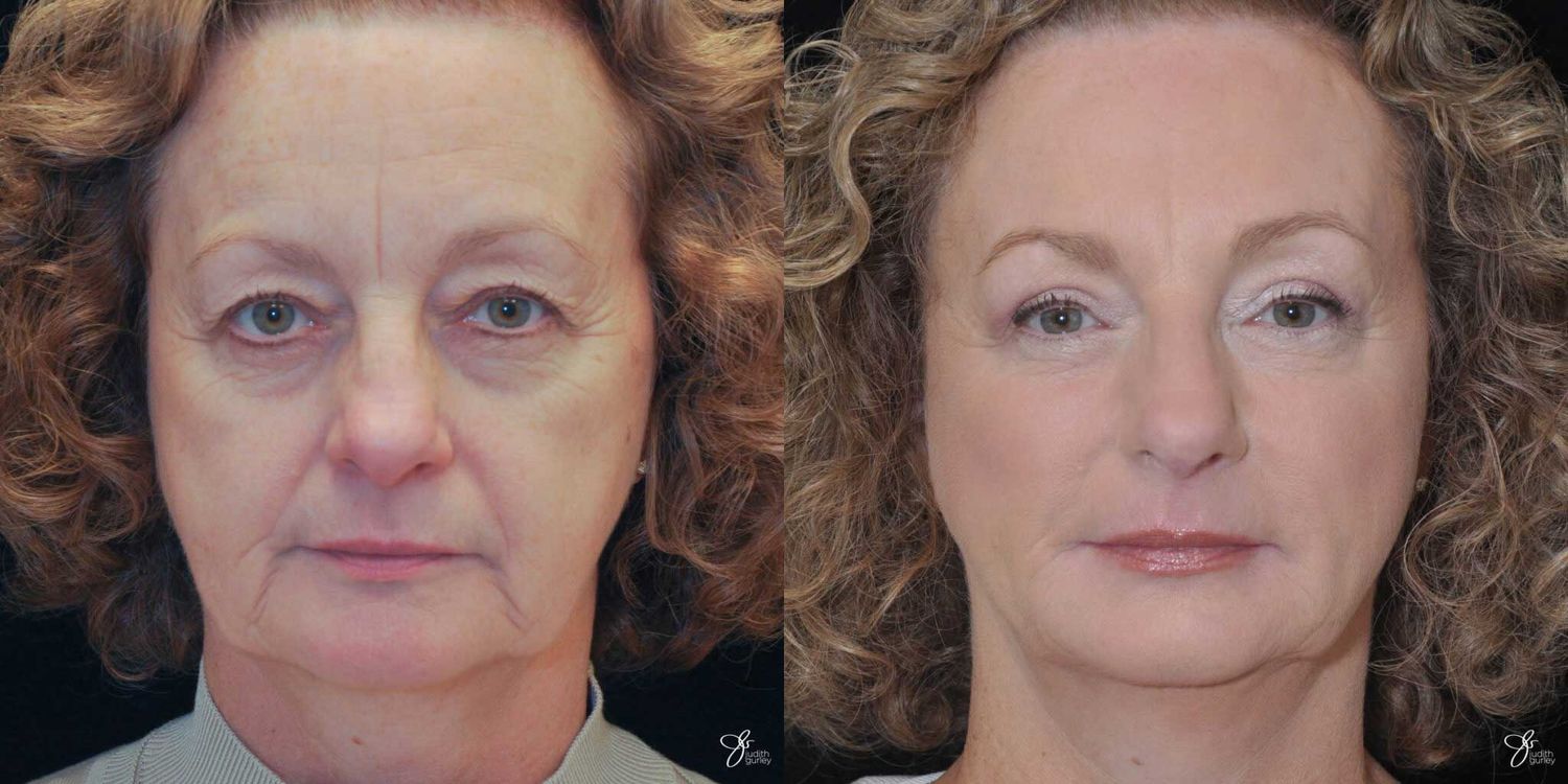 Facial Fat Grafting Before & After