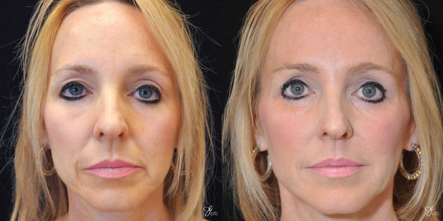 Facial Fat Grafting Before & After