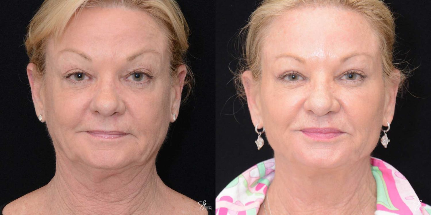 Facial Fat Grafting Before & After