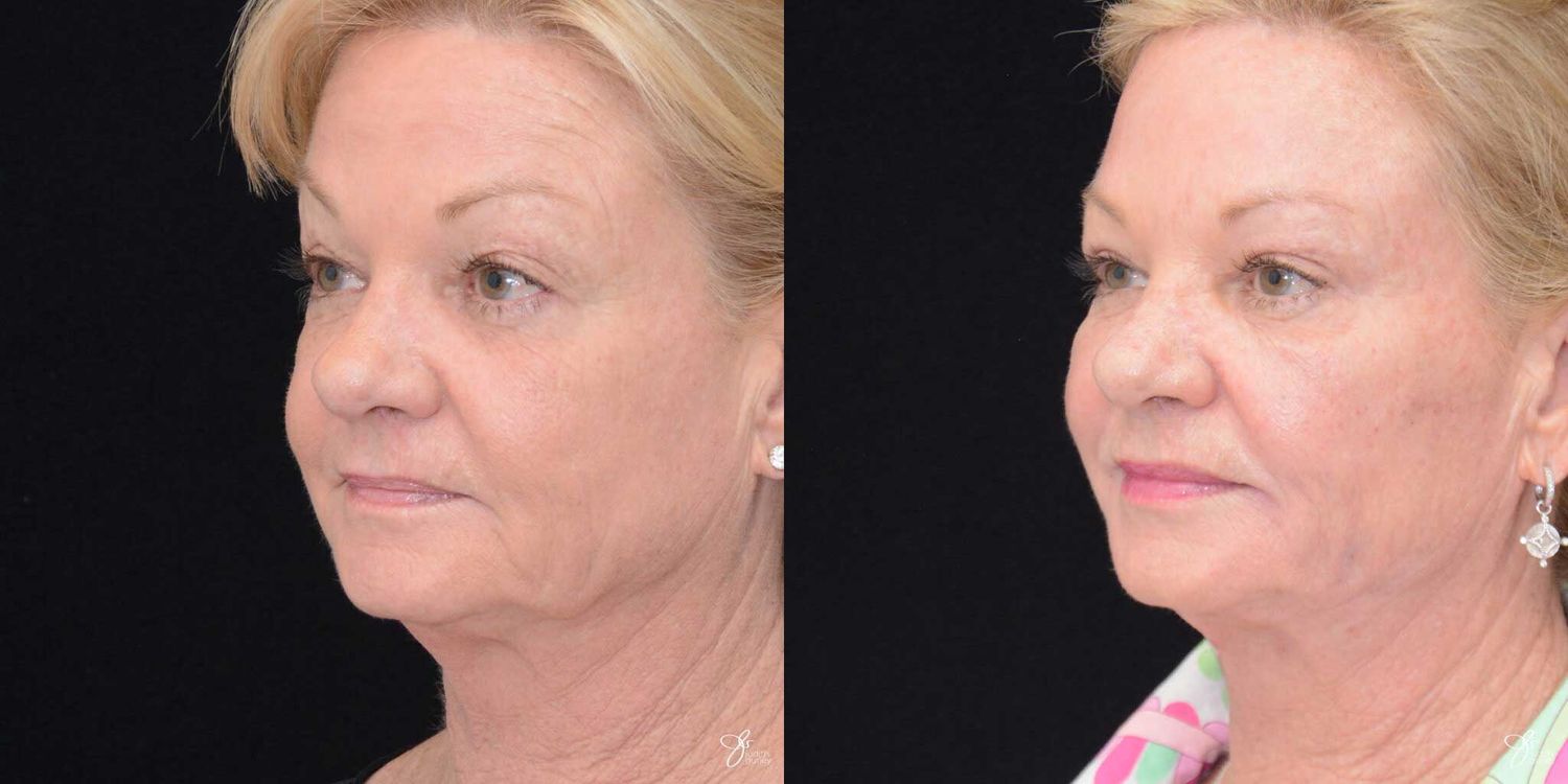 Facial Fat Grafting Before & After
