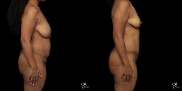 Mommy Makeover Before & After