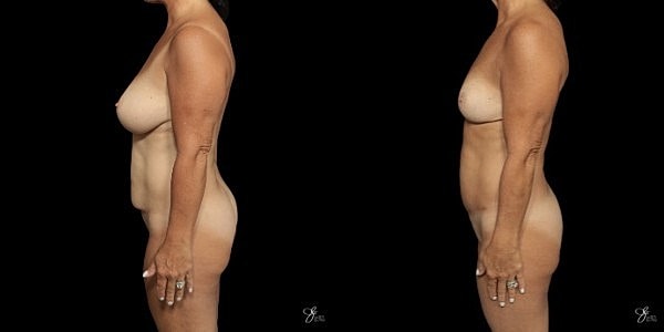 Mommy Makeover Before & After