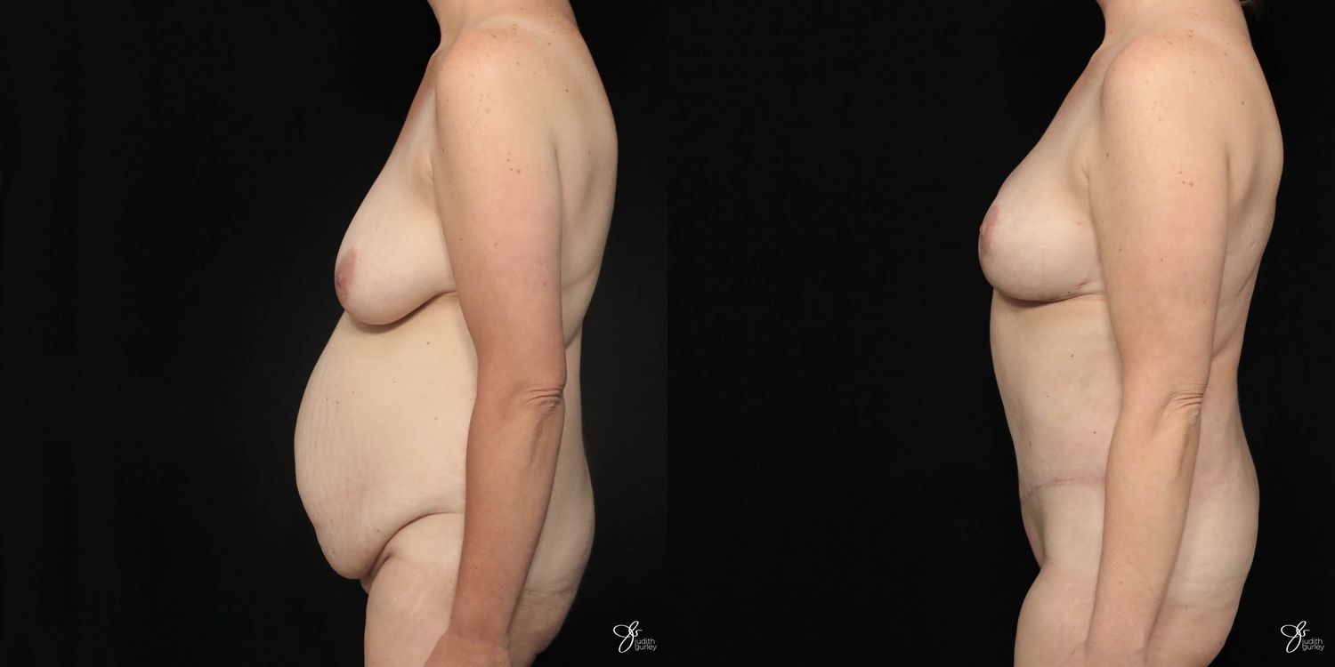 Mommy Makeover Before & After