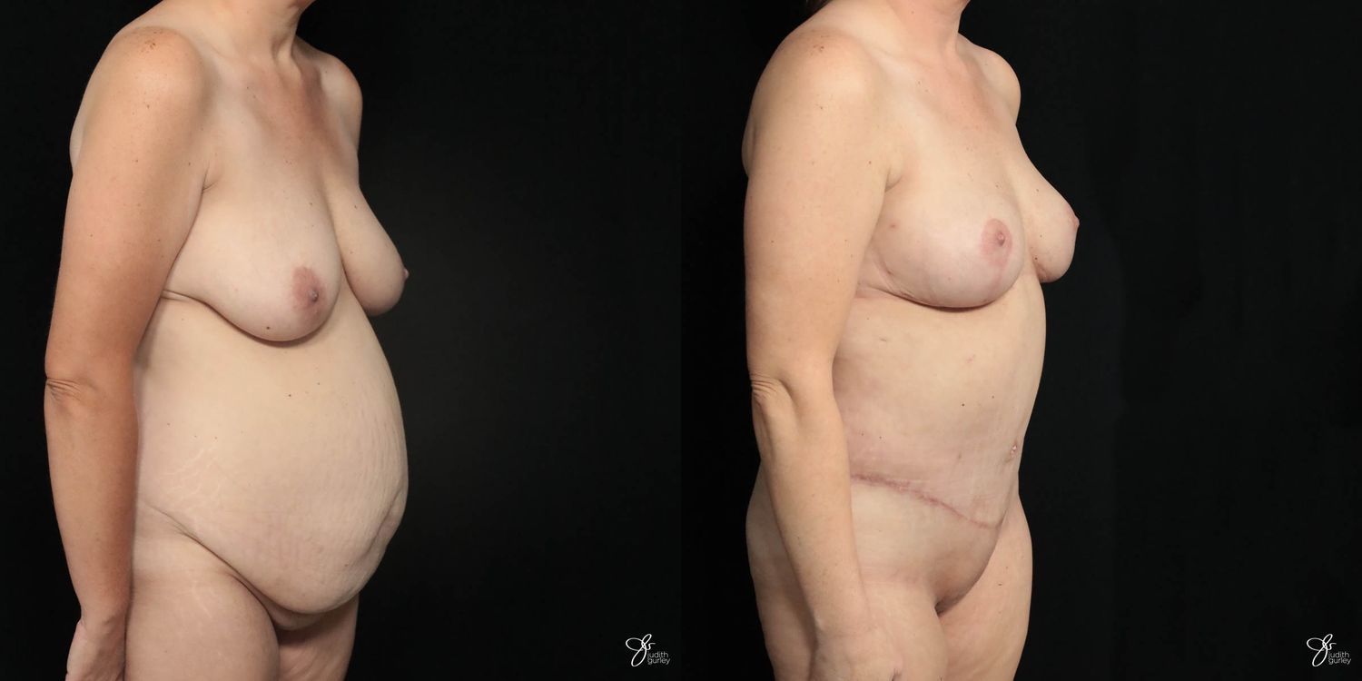 Mommy Makeover Before & After