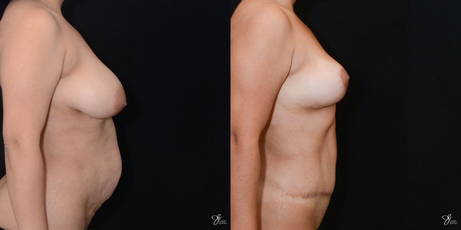 Mommy Makeover Before & After