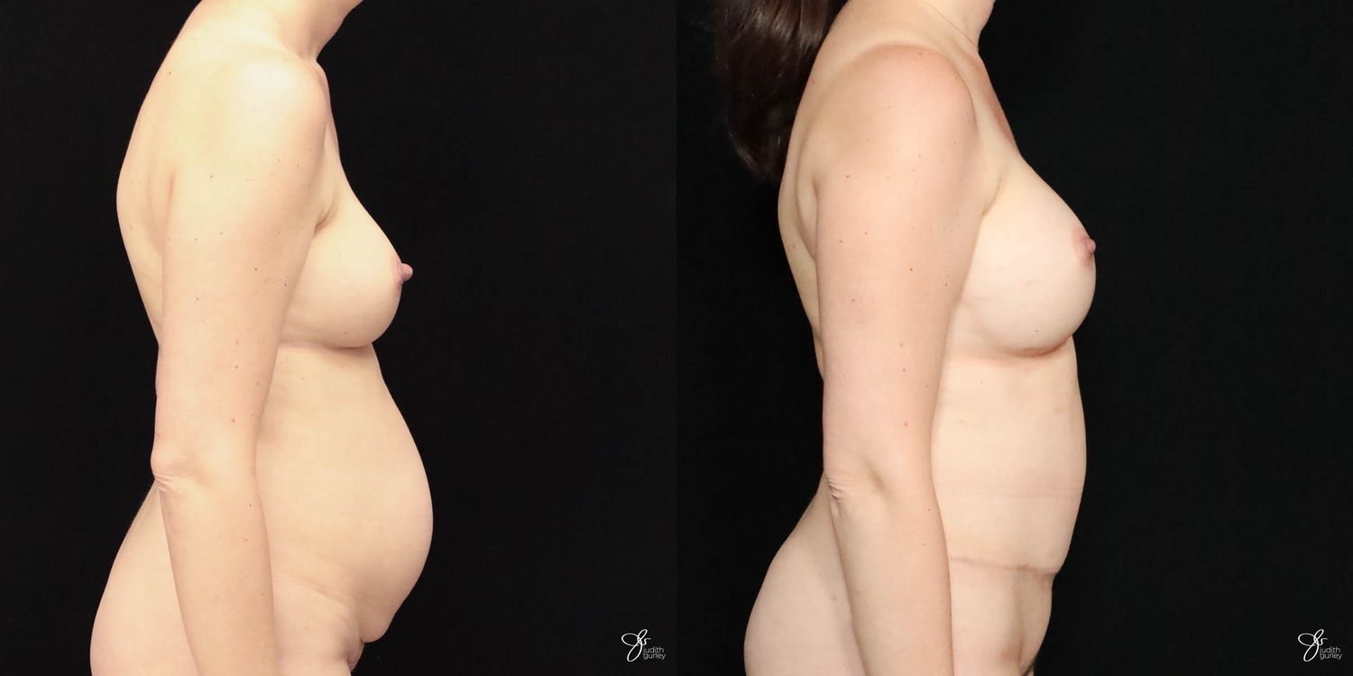 Mommy Makeover Before & After