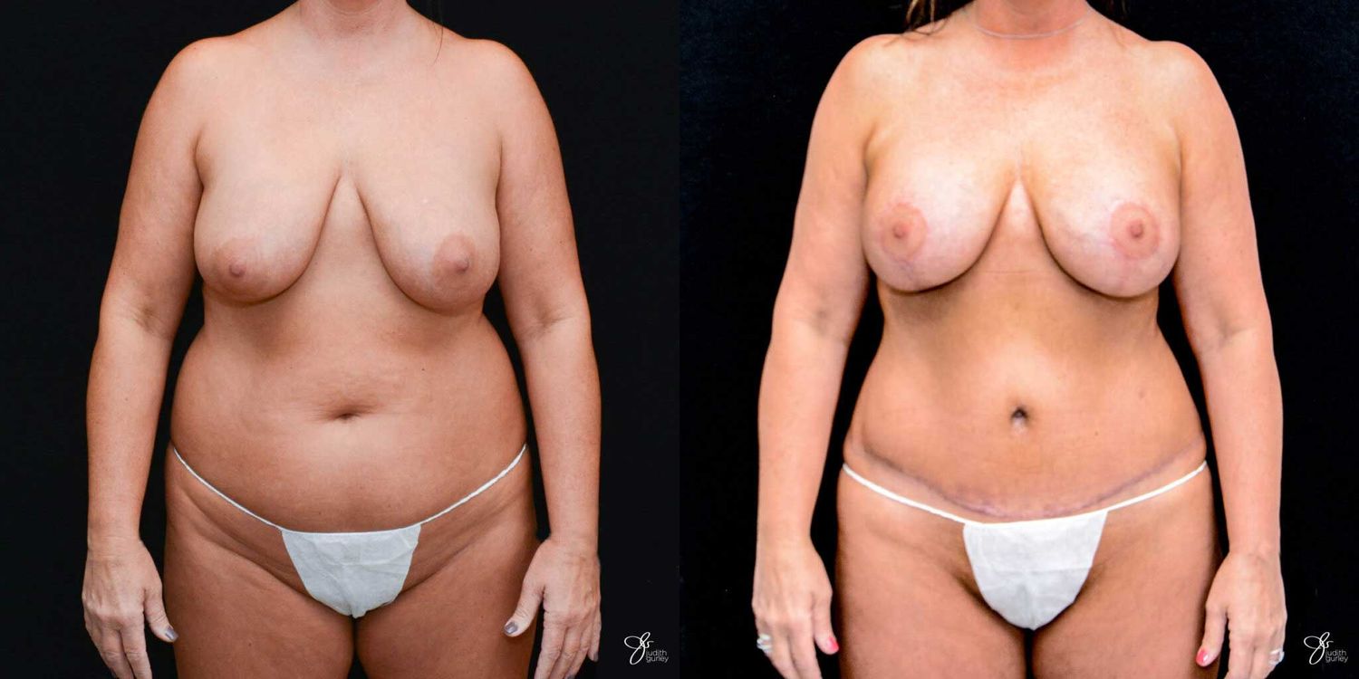 Mommy Makeover Before & After