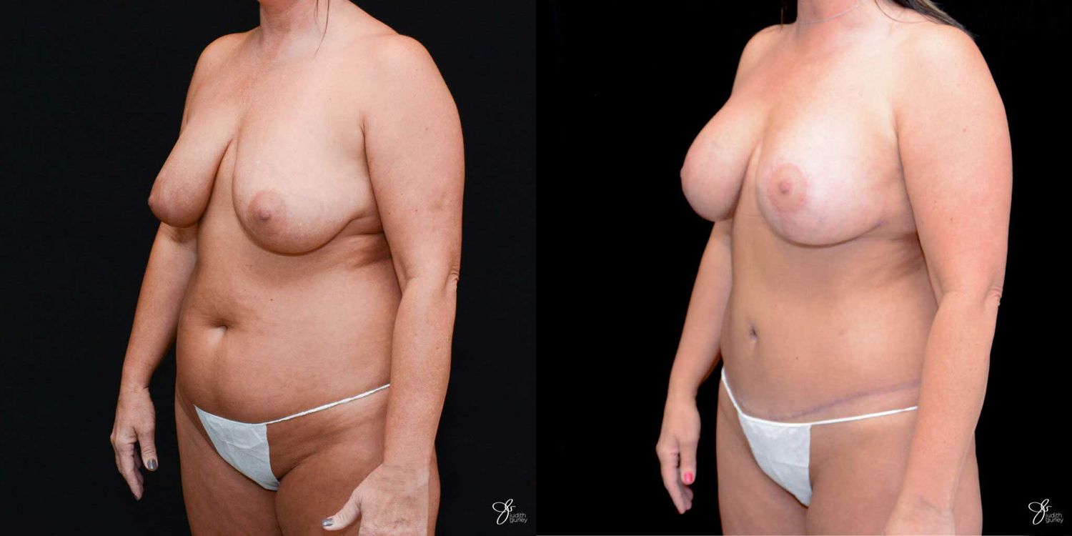 Mommy Makeover Before & After