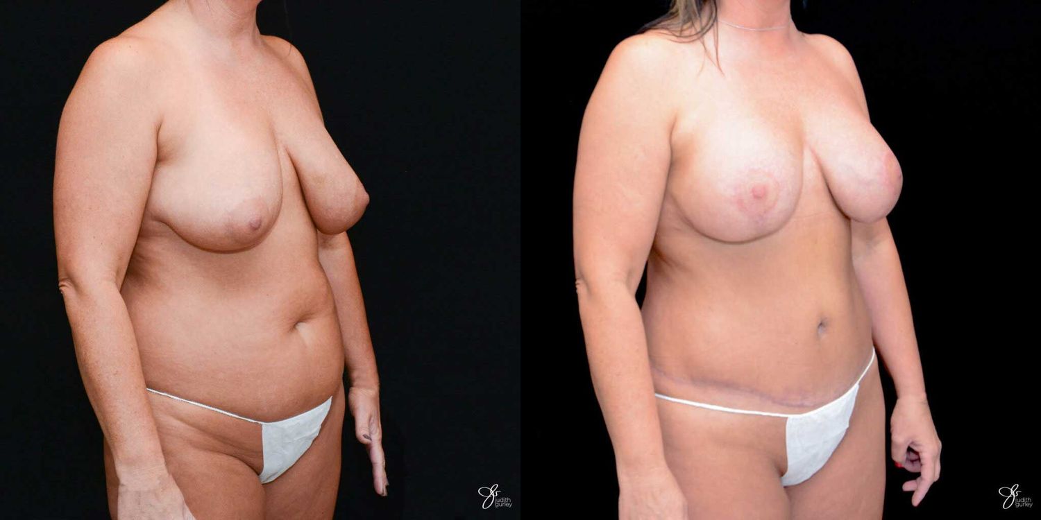 Mommy Makeover Before & After