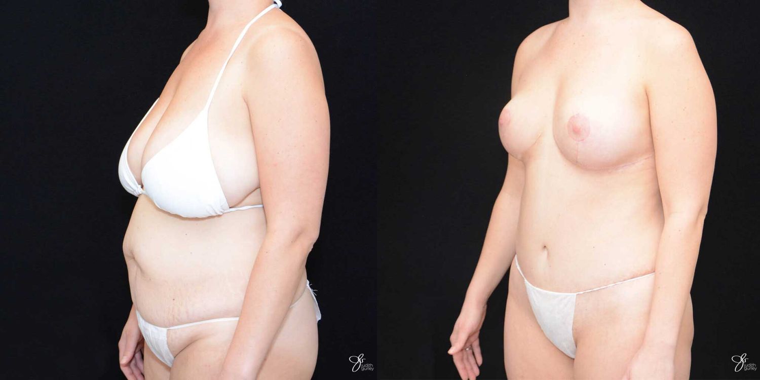 Mommy Makeover Before & After