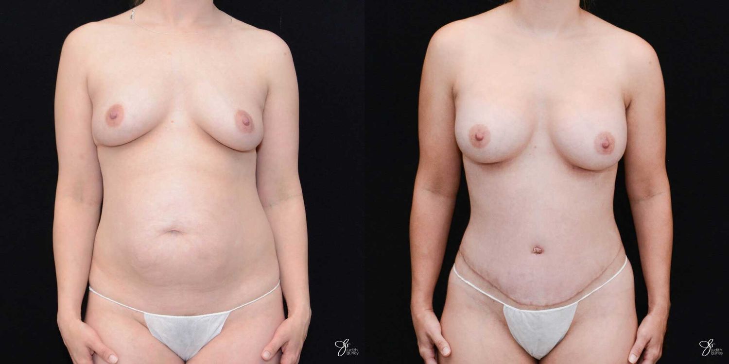 Mommy Makeover Before & After