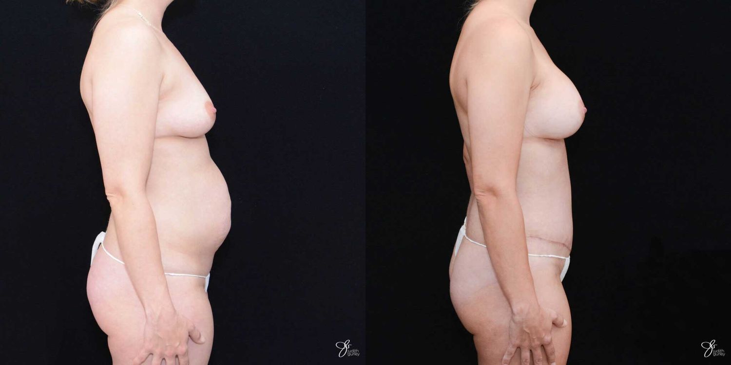 Mommy Makeover Before & After