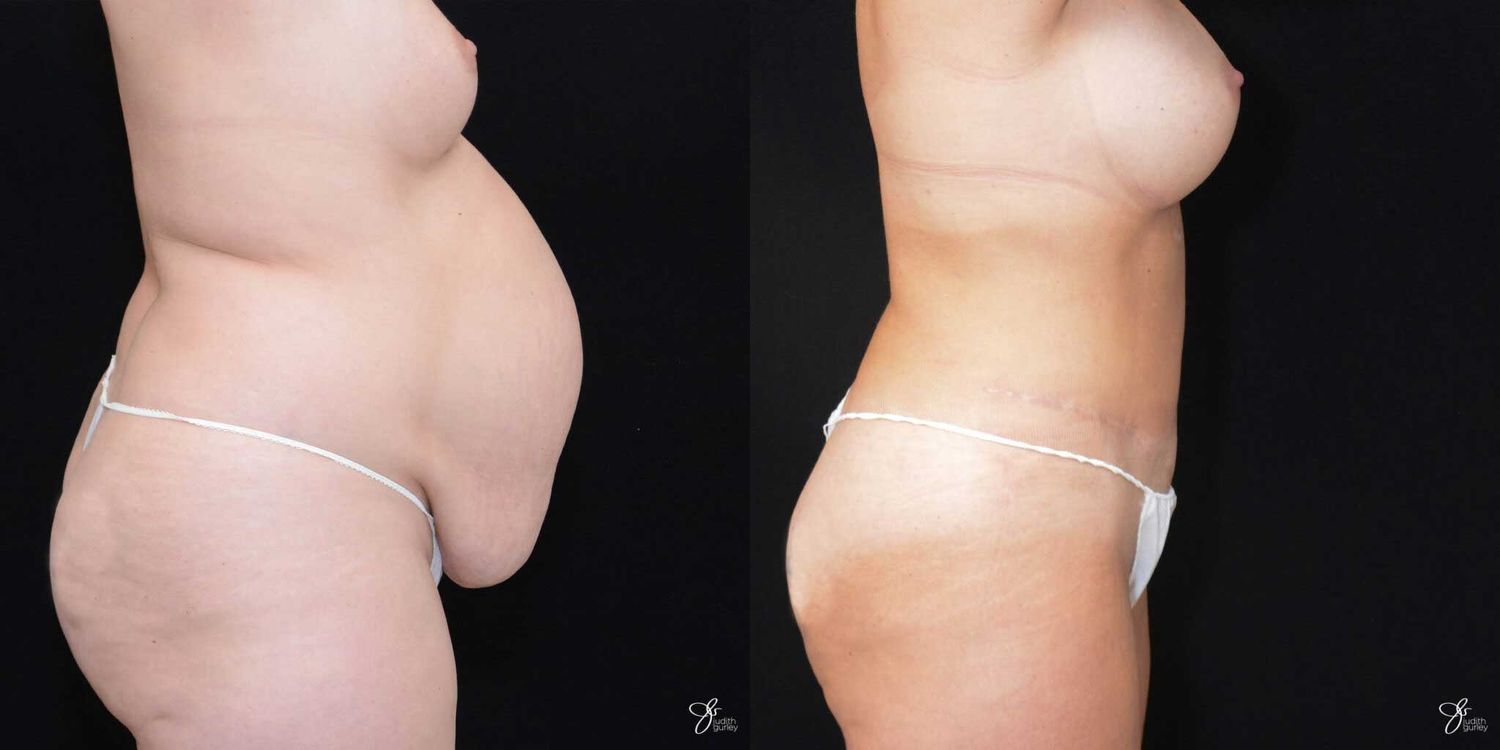 Mommy Makeover Before & After