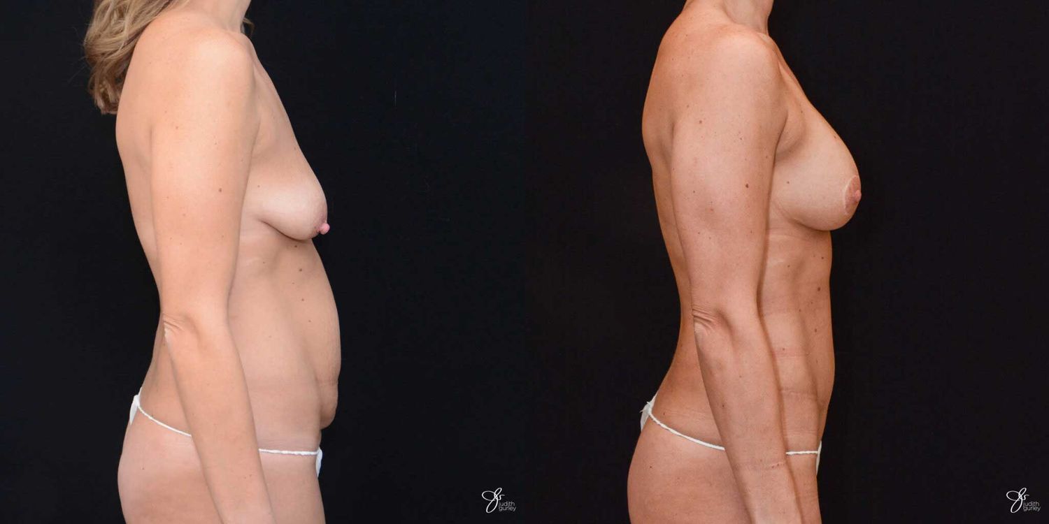 Mommy Makeover Before & After