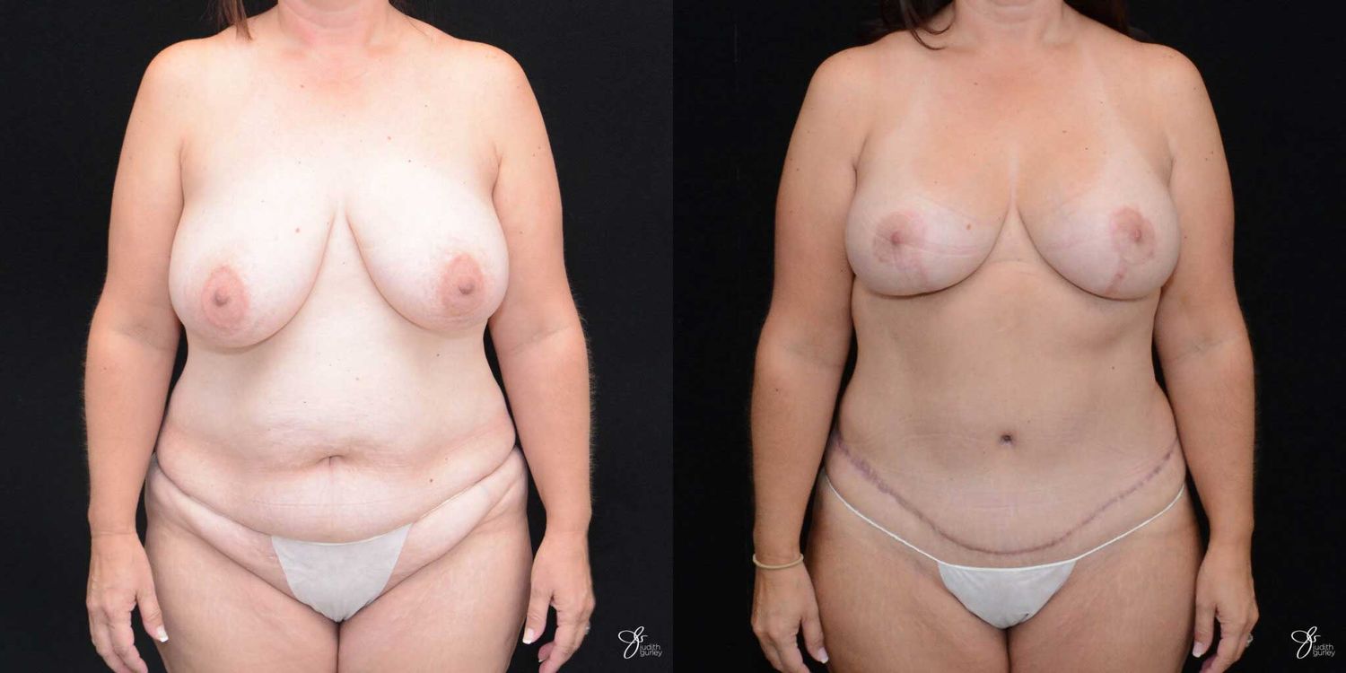 Mommy Makeover Before & After